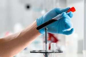 Health care worker handling a test sample in a clinic laboratory, representing HIV testing efforts in coastal Alabama